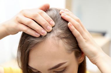 Garota perdendo o cabelo e iniciando um tratamento com remédios manipulados